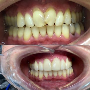A person showing his teeth before and after dental treatment in Fort Lee, NJ