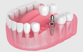 An Overview of Dental Bridges to Replace Missing Tooth