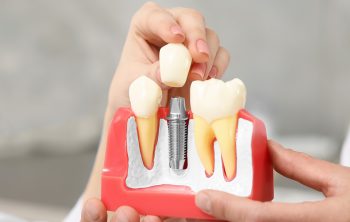 What is the need for a bone graft before receiving dental implants?